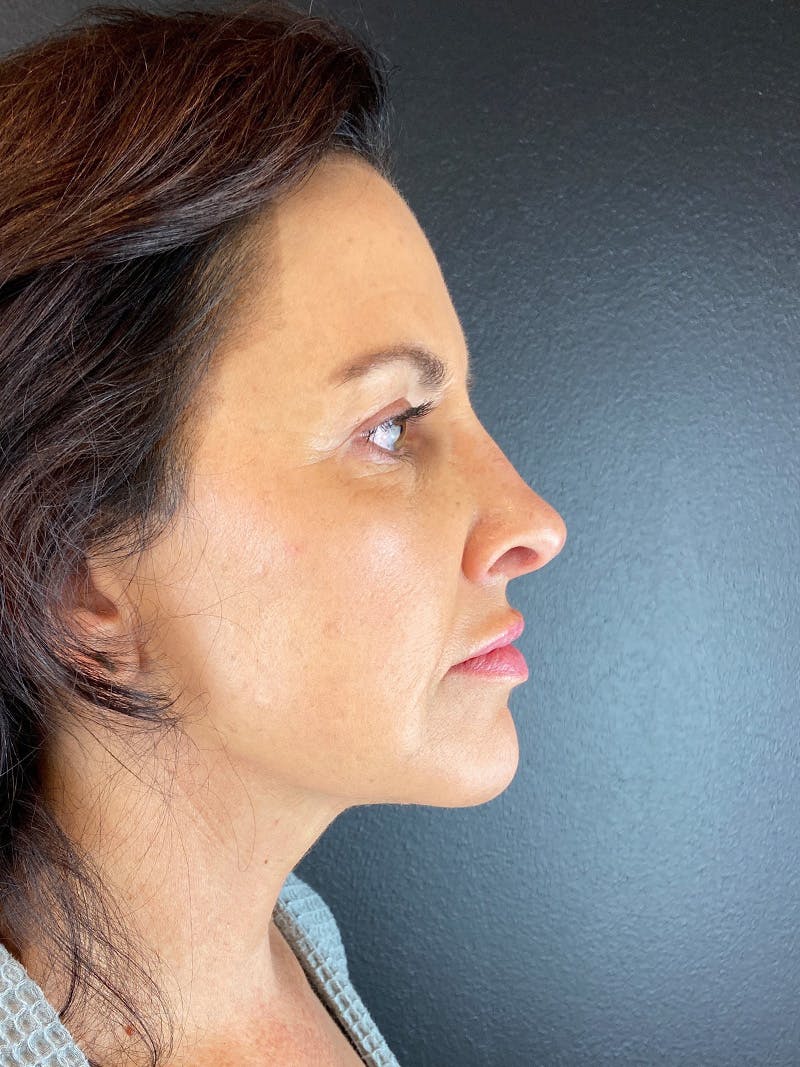 Panfacial Fat Grafting Before & After Gallery - Patient 282148 - Image 4