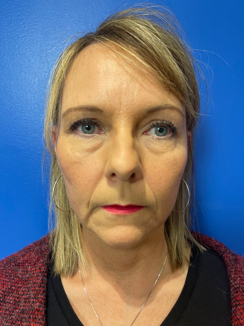 Panfacial Fat Grafting Before & After Gallery - Patient 320734 - Image 1