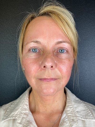 Panfacial Fat Grafting Before & After Gallery - Patient 320734 - Image 2