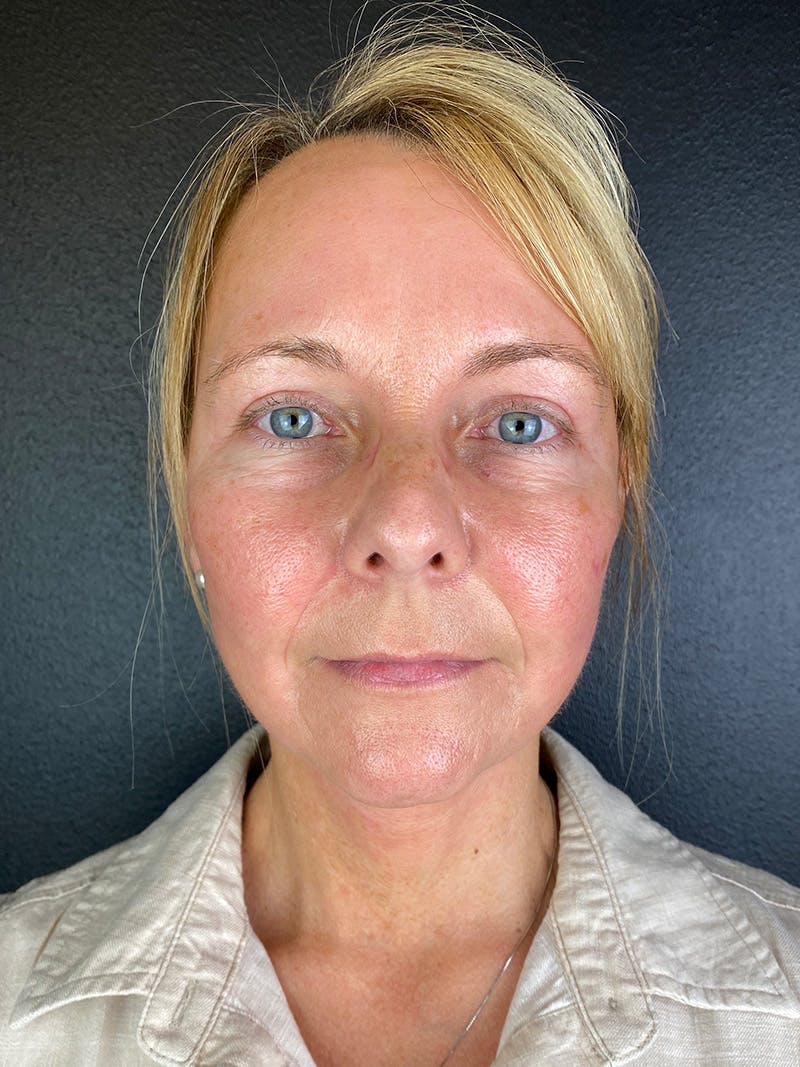Panfacial Fat Grafting Before & After Gallery - Patient 320734 - Image 2
