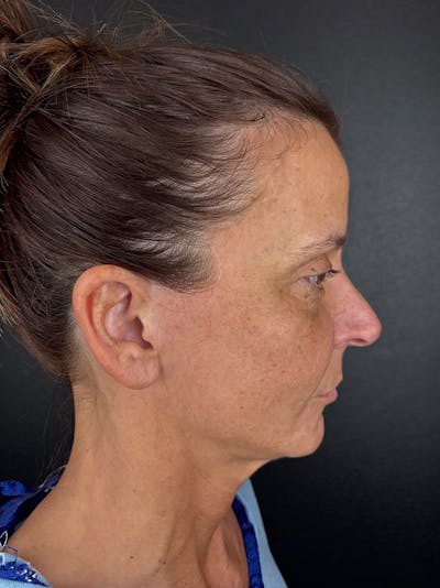 Panfacial Fat Grafting Before & After Gallery - Patient 866964 - Image 1