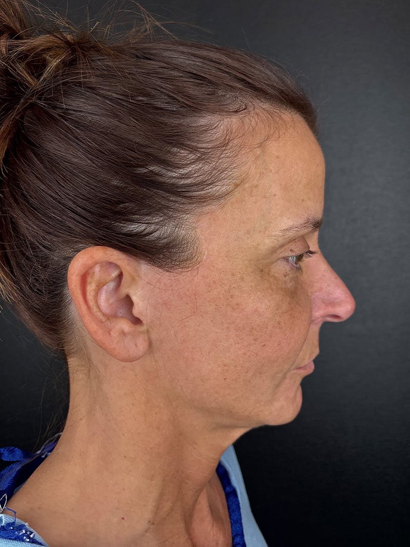 Panfacial Fat Grafting Before & After Gallery - Patient 866964 - Image 1