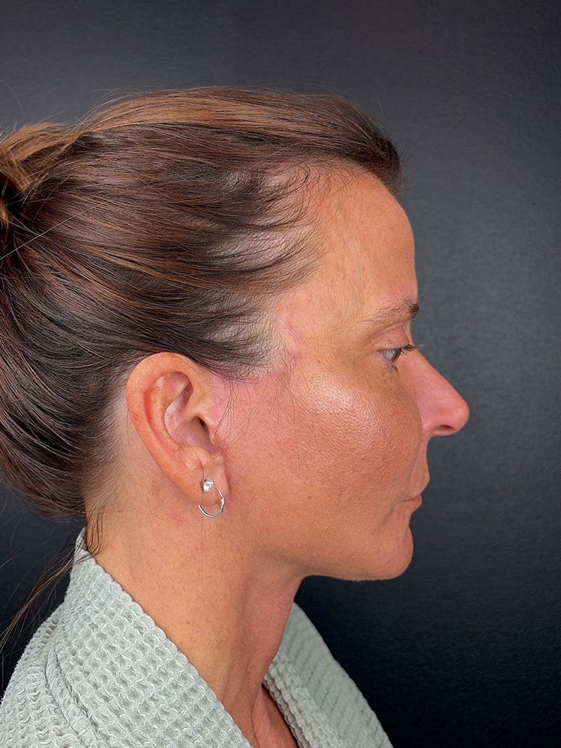 Panfacial Fat Grafting Before & After Gallery - Patient 866964 - Image 2