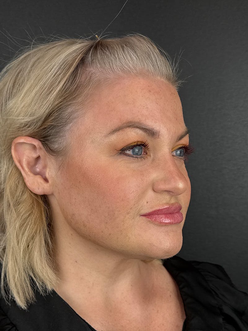Panfacial Fat Grafting Before & After Gallery - Patient 173783 - Image 4
