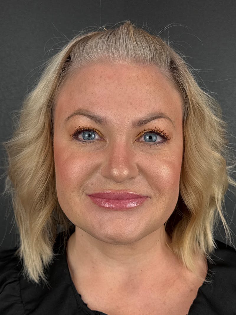 Panfacial Fat Grafting Before & After Gallery - Patient 173783 - Image 2