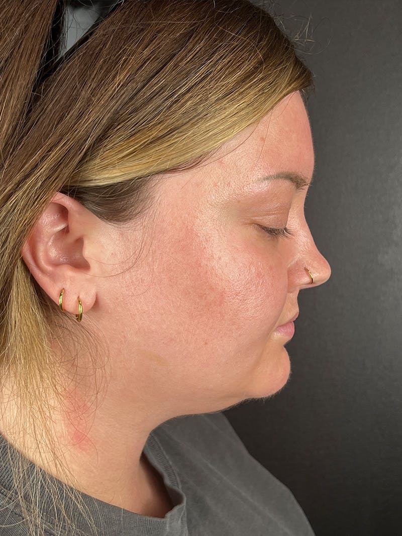 Submental Liposuction Before & After Gallery - Patient 334164 - Image 1