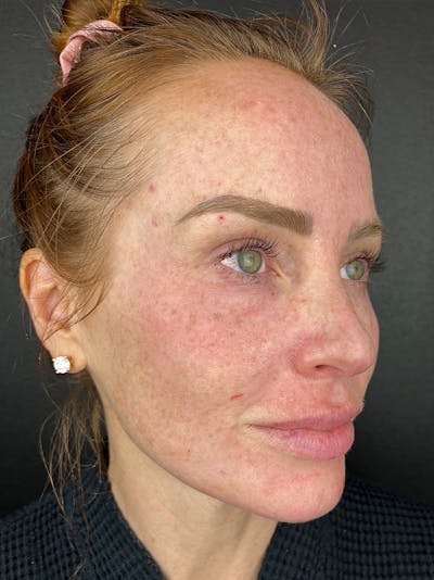 Hairline Advancement Before & After Gallery - Patient 191951 - Image 1