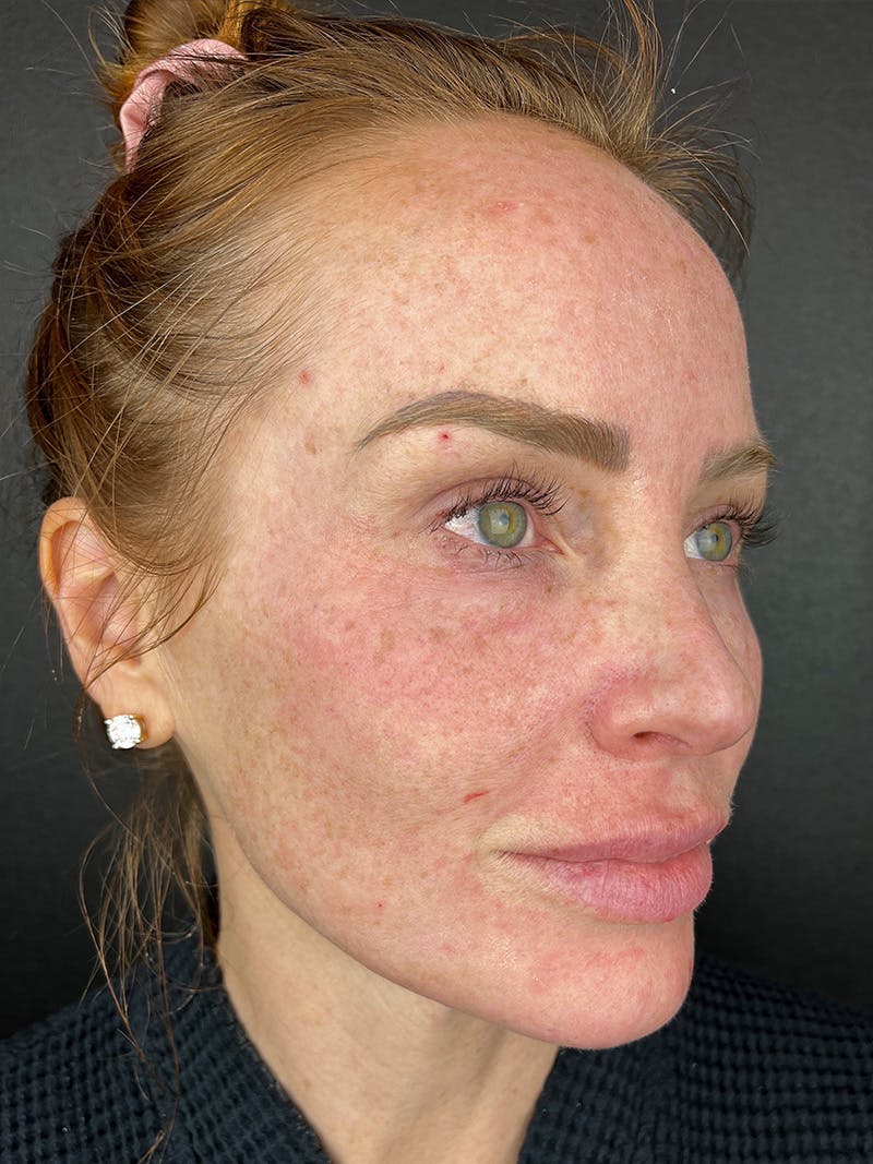 Hairline Advancement Before & After Gallery - Patient 191951 - Image 1