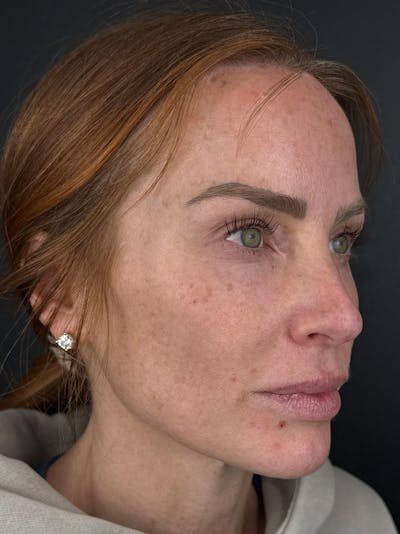 Hairline Advancement Before & After Gallery - Patient 191951 - Image 2