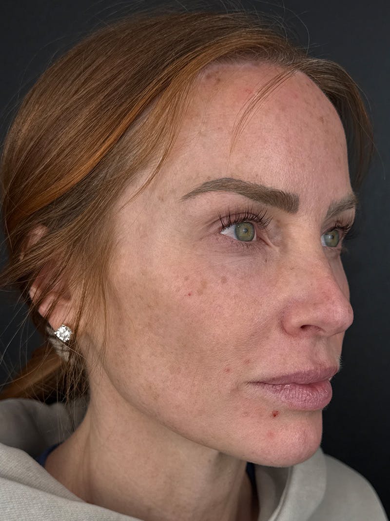 Hairline Advancement Before & After Gallery - Patient 191951 - Image 2