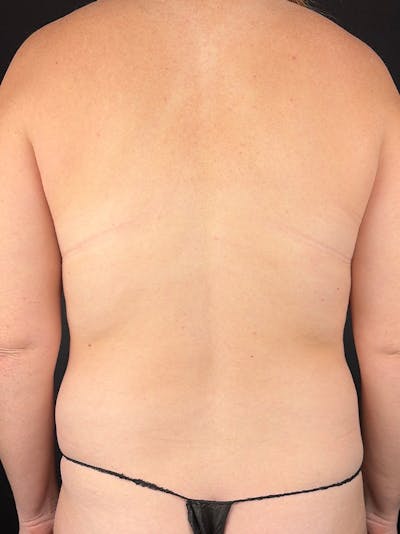 Back (Liposuction) Before & After Gallery - Patient 436252 - Image 1