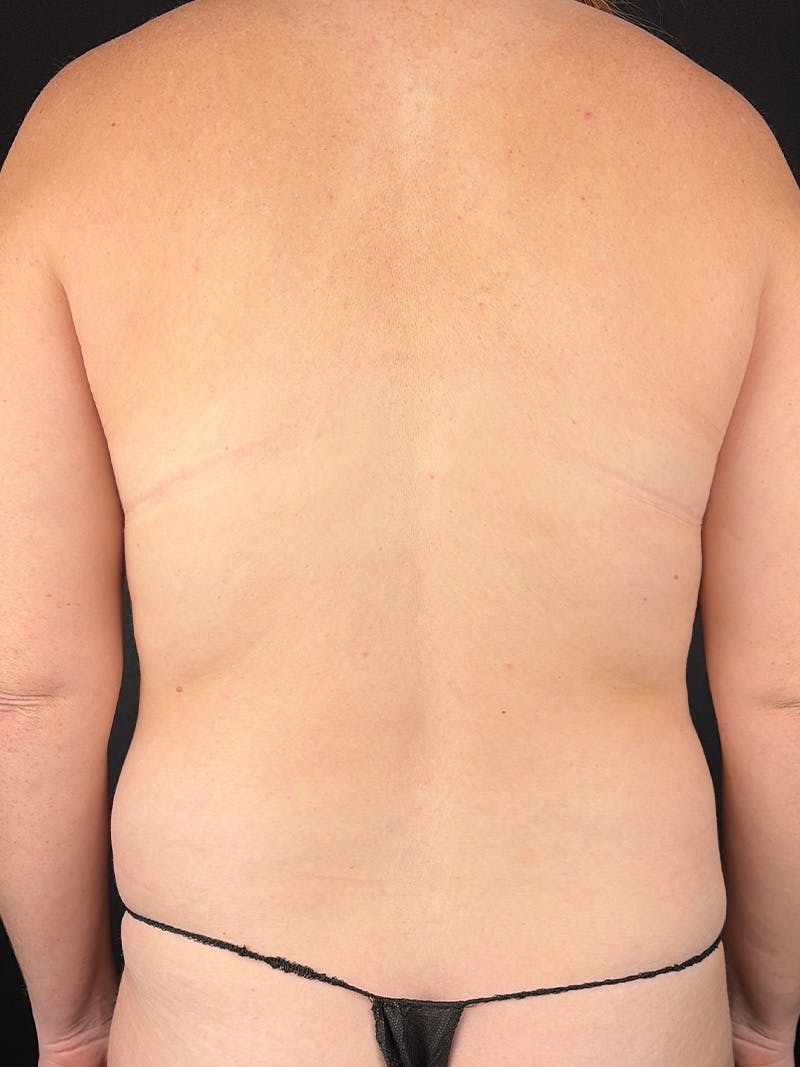Back (Liposuction) Before & After Gallery - Patient 436252 - Image 1