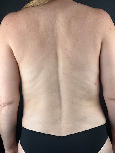 Back (Liposuction) Before & After Gallery - Patient 436252 - Image 2