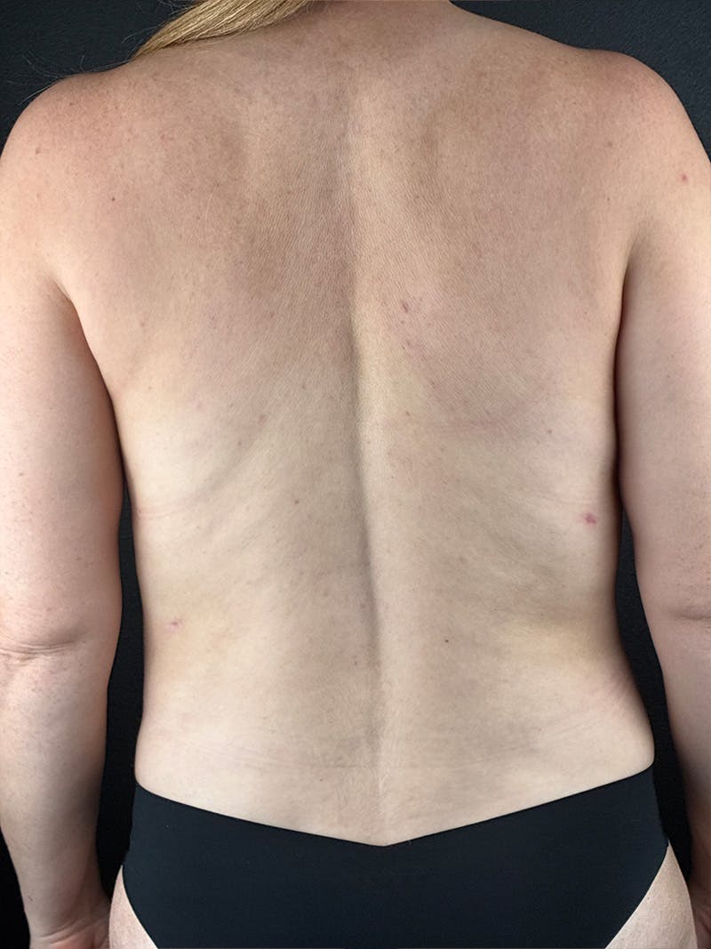 Back (Liposuction) Before & After Gallery - Patient 436252 - Image 2