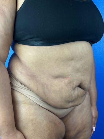 Tummy Tuck Before & After Gallery - Patient 177620 - Image 1