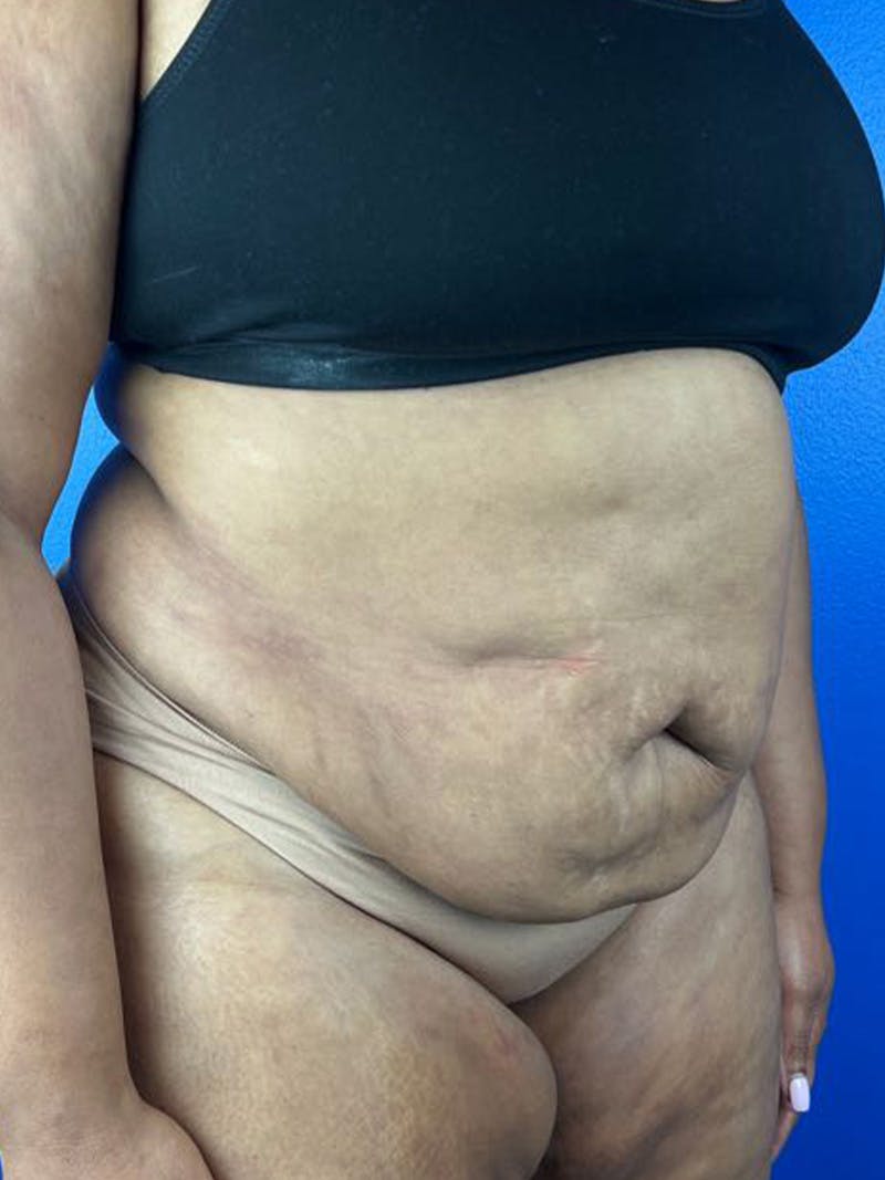 Tummy Tuck Before & After Gallery - Patient 177620 - Image 1