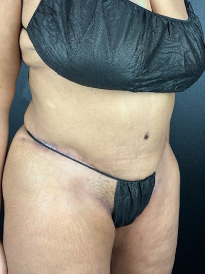 Tummy Tuck Before & After Gallery - Patient 177620 - Image 2