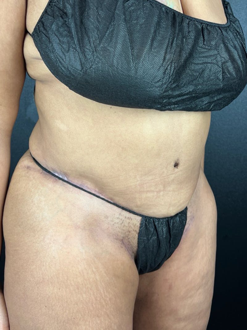 Tummy Tuck Before & After Gallery - Patient 177620 - Image 2