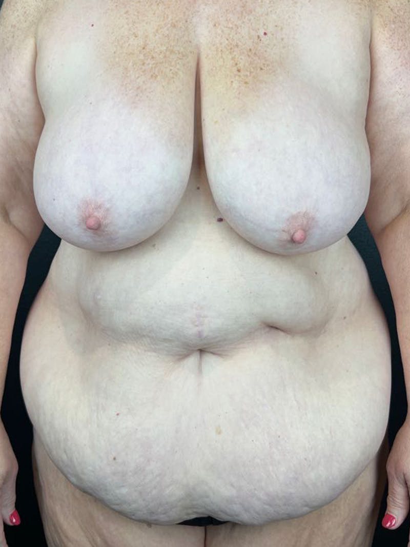 Tummy Tuck Before & After Gallery - Patient 324432 - Image 1
