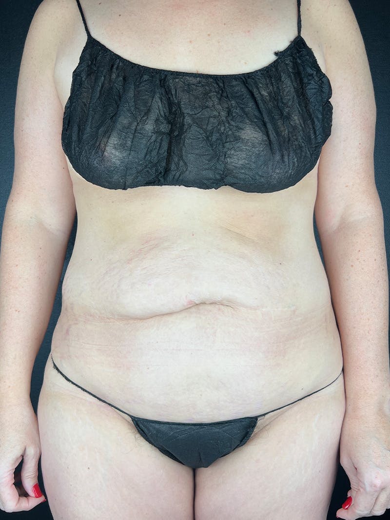 Tummy Tuck Before & After Gallery - Patient 364475 - Image 1