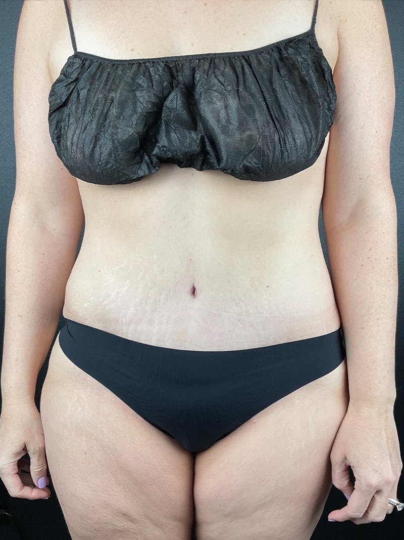 Tummy Tuck Before & After Gallery - Patient 364475 - Image 2