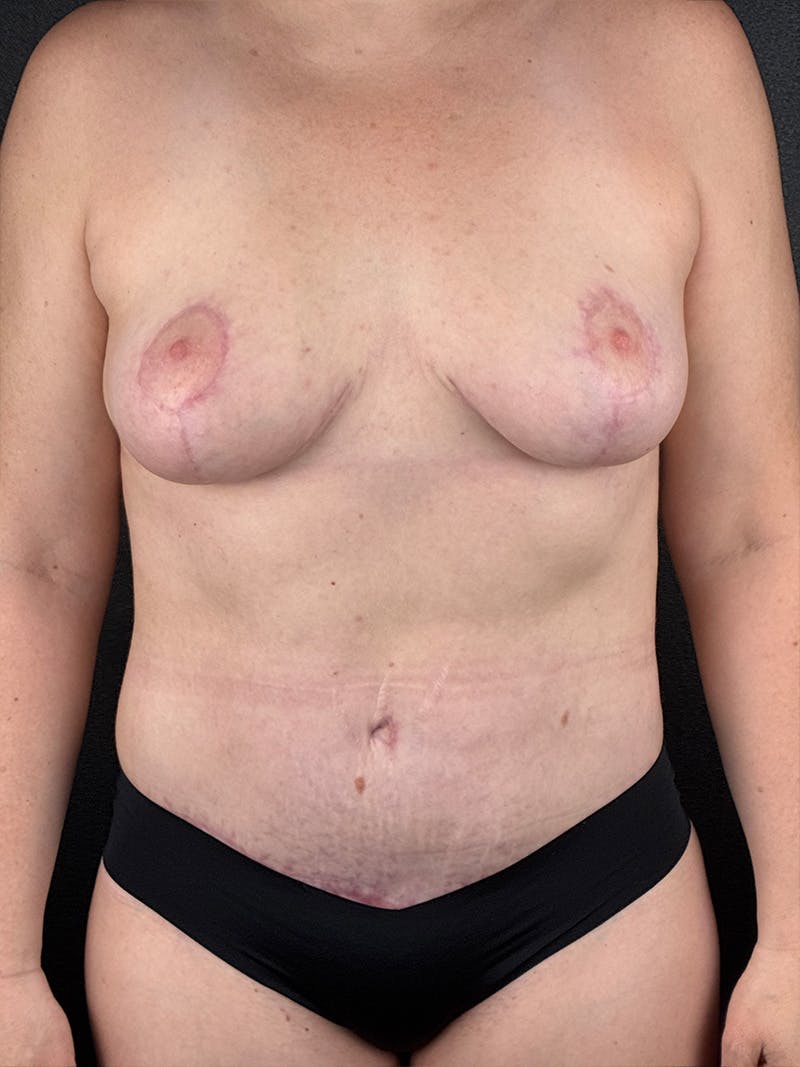 Tummy Tuck Before & After Gallery - Patient 354099 - Image 2