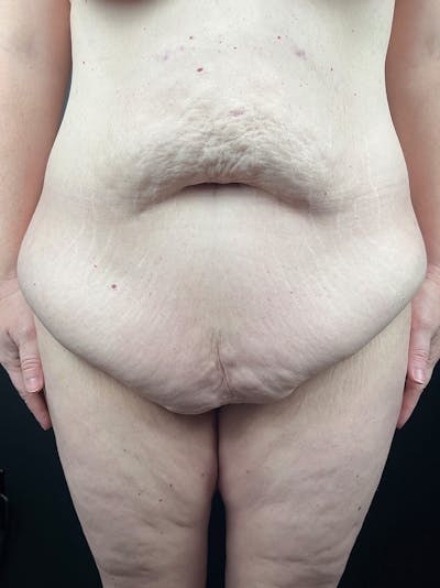 Tummy Tuck Before & After Gallery - Patient 299166 - Image 1