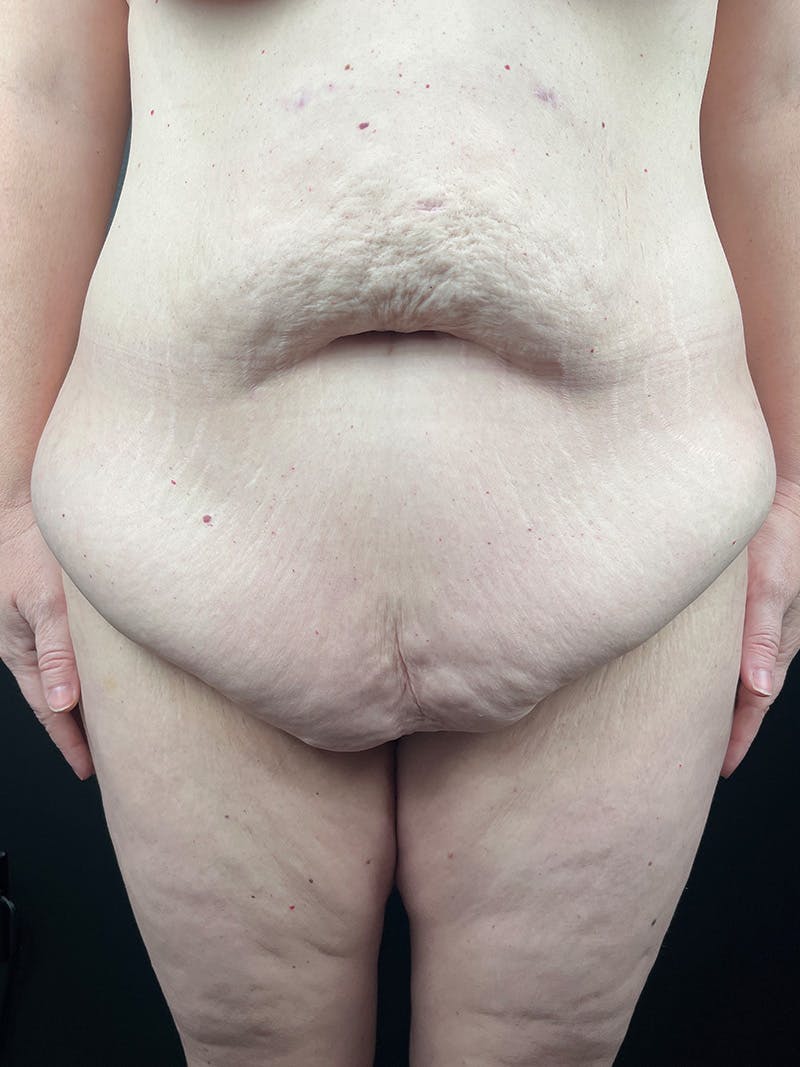 Tummy Tuck Before & After Gallery - Patient 299166 - Image 1