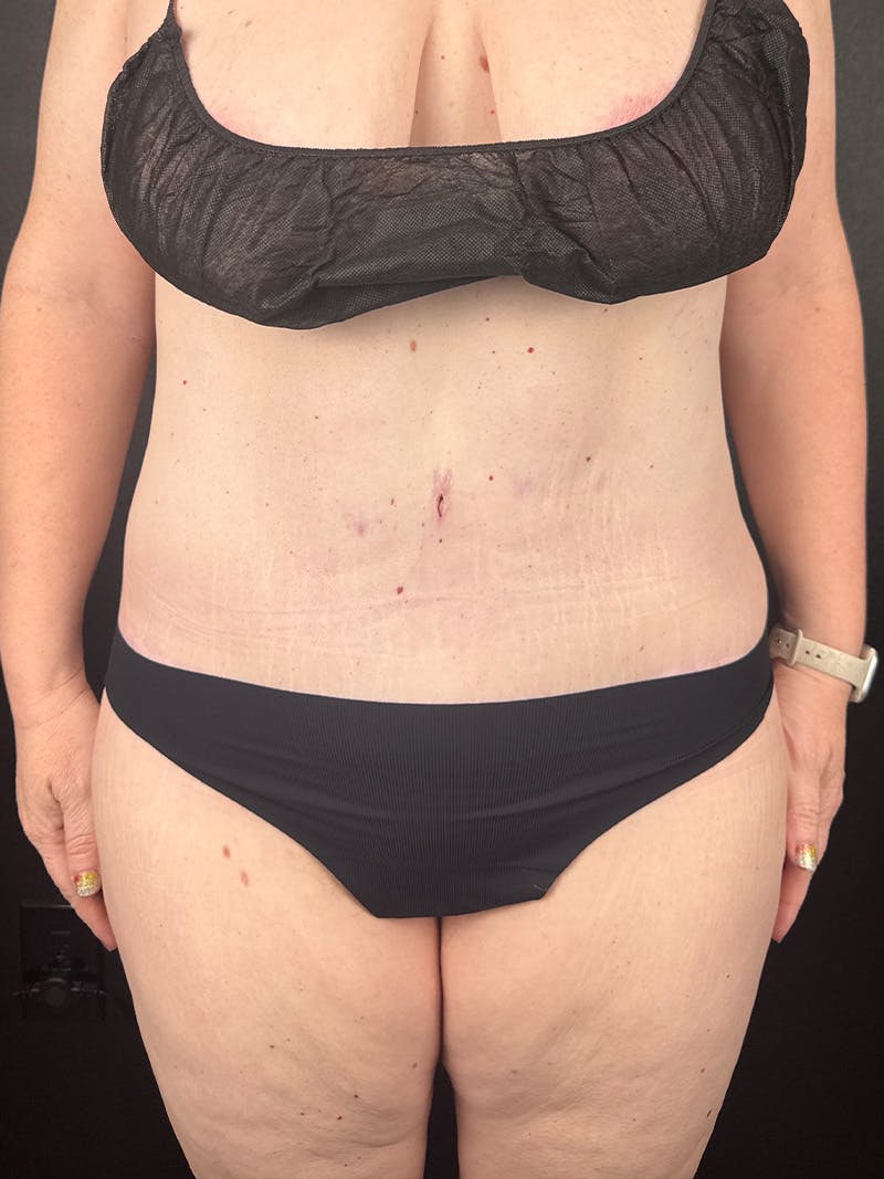 Tummy Tuck Before & After Gallery - Patient 299166 - Image 2