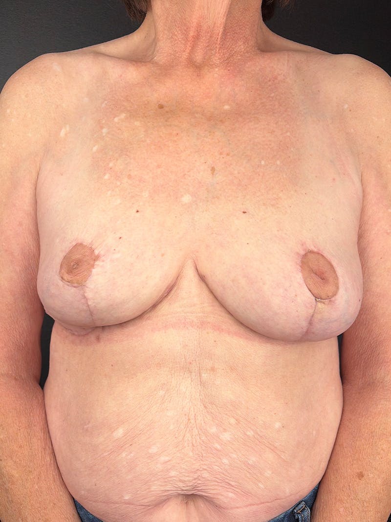 Explant with Breast Lift Before & After Gallery - Patient 389258 - Image 2