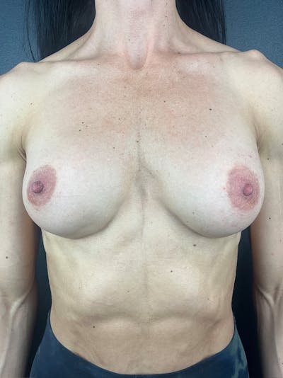 Breast Implant Exchange Before & After Gallery - Patient 407571 - Image 1