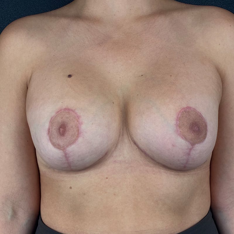 Breast Lift with Implants Before & After Gallery - Patient 372534 - Image 2