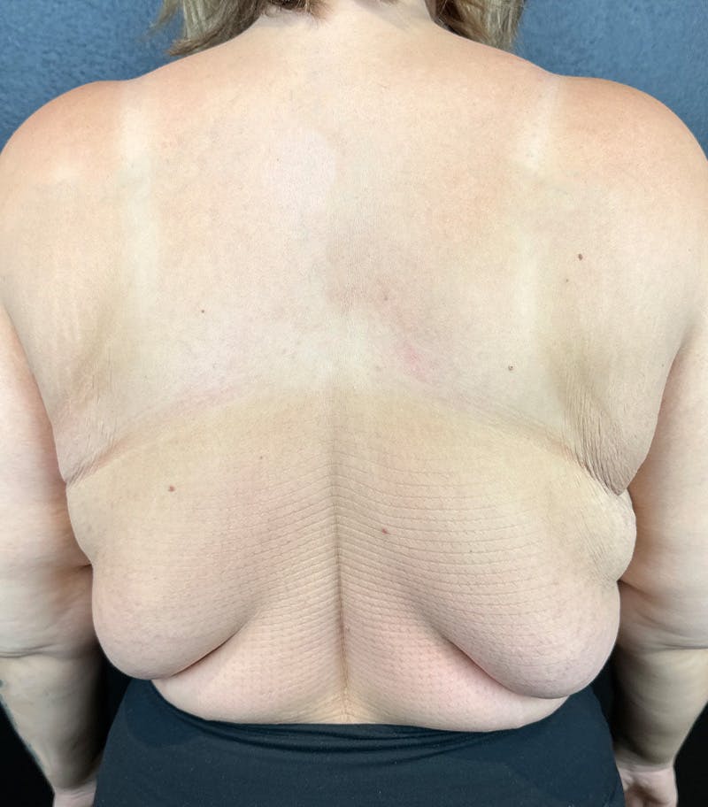 Upper Back Lift Before & After Gallery - Patient 353997 - Image 1