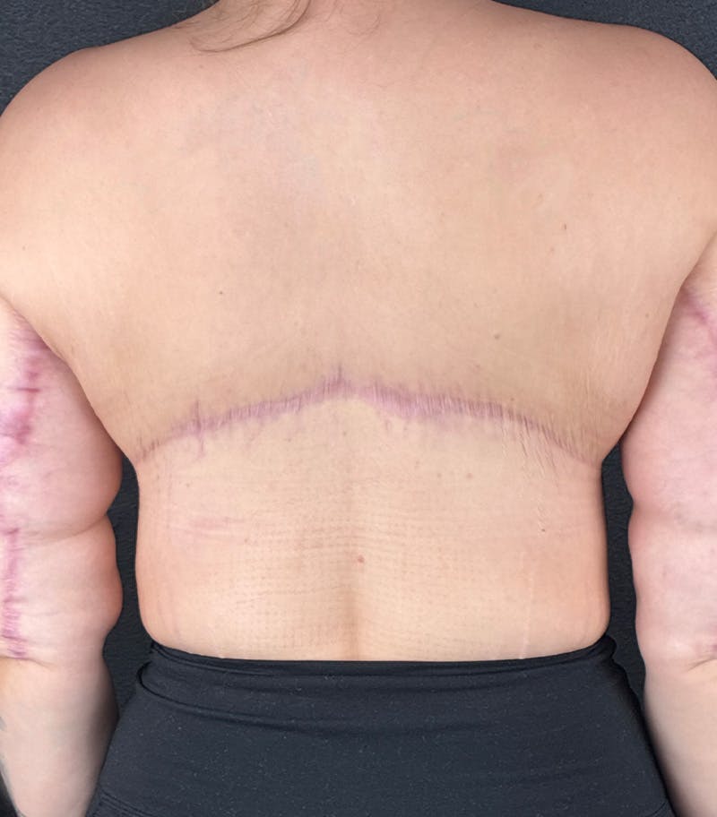Upper Back Lift Before & After Gallery - Patient 353997 - Image 2