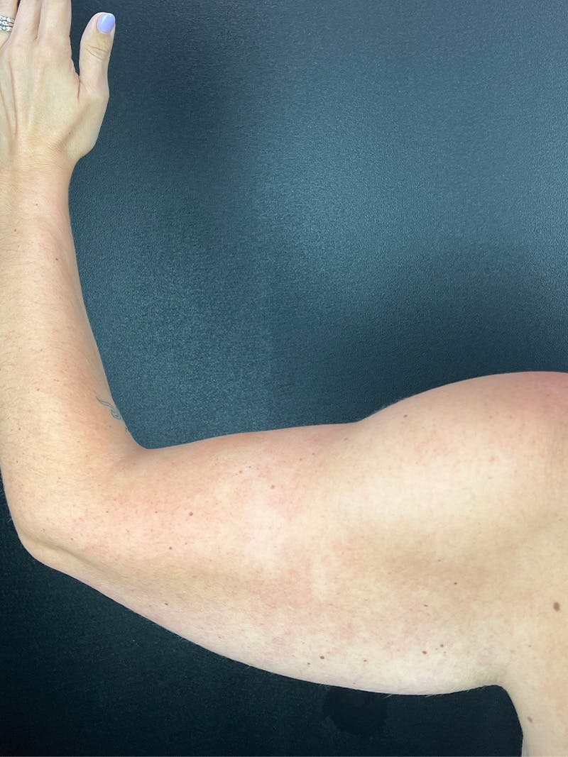 Arm Lift Before & After Gallery - Patient 317057 - Image 1