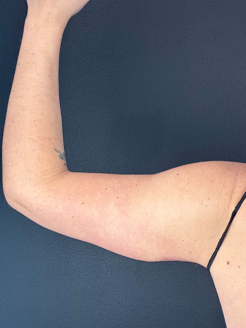 Arm Lift Before & After Gallery - Patient 317057 - Image 2