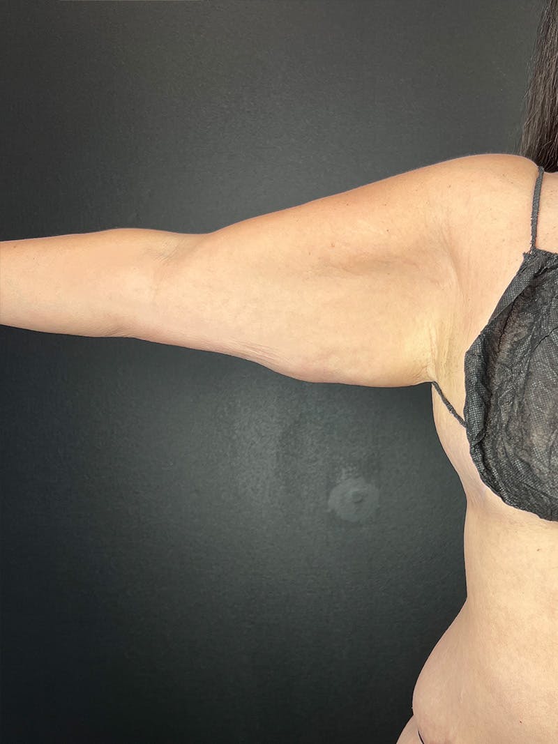 Arm Lift Before & After Gallery - Patient 248727 - Image 1