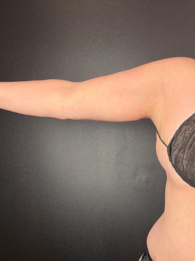 Arm Lift Before & After Gallery - Patient 248727 - Image 2