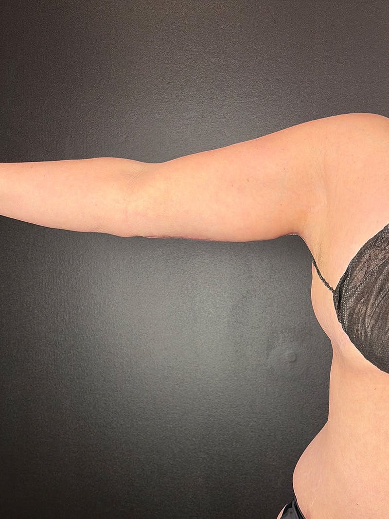 Arm Lift Before & After Gallery - Patient 248727 - Image 2
