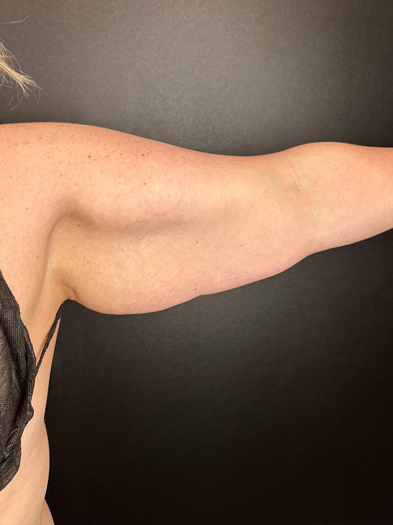 Arm Lift Before & After Gallery - Patient 162816 - Image 1
