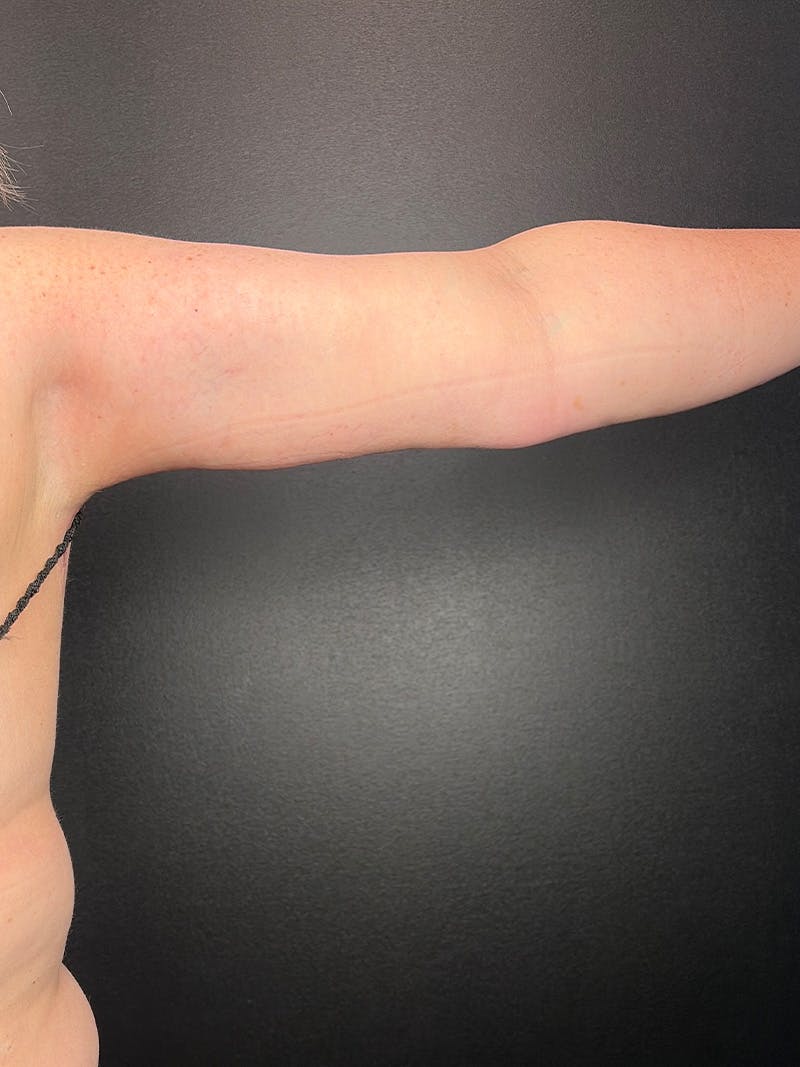 Arm Lift Before & After Gallery - Patient 162816 - Image 2