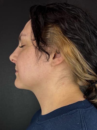 Submental Liposuction Before & After Gallery - Patient 105449 - Image 2