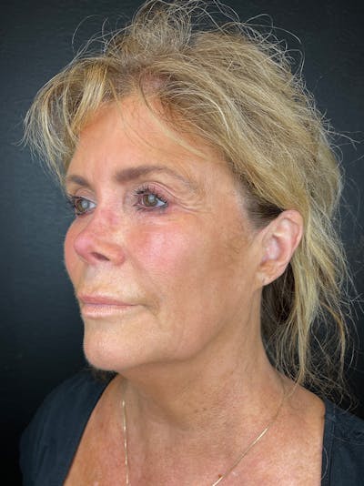 Neck Lift Before & After Gallery - Patient 383332 - Image 1