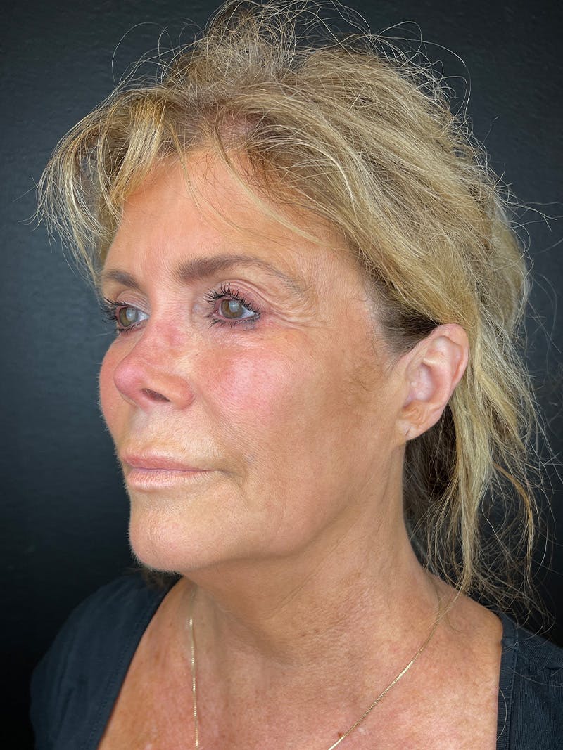 Neck Lift Before & After Gallery - Patient 383332 - Image 1