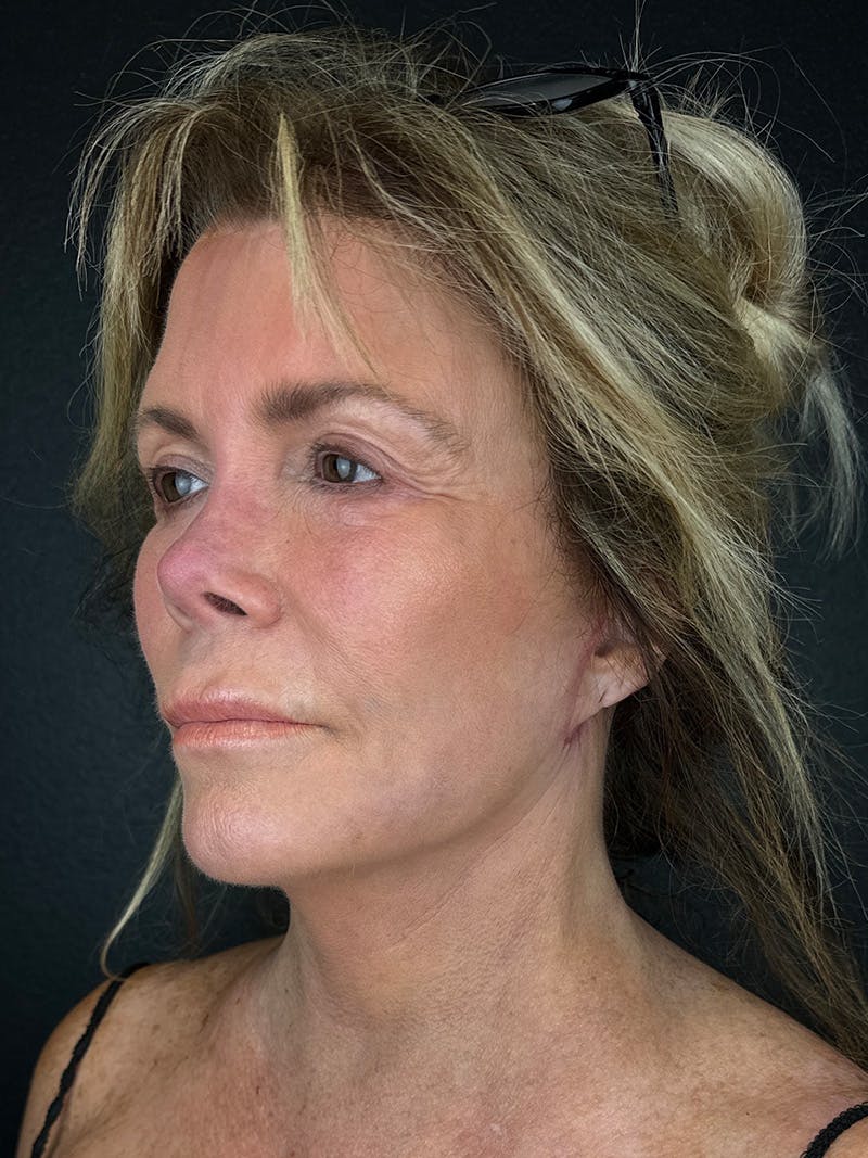 Neck Lift Before & After Gallery - Patient 383332 - Image 2