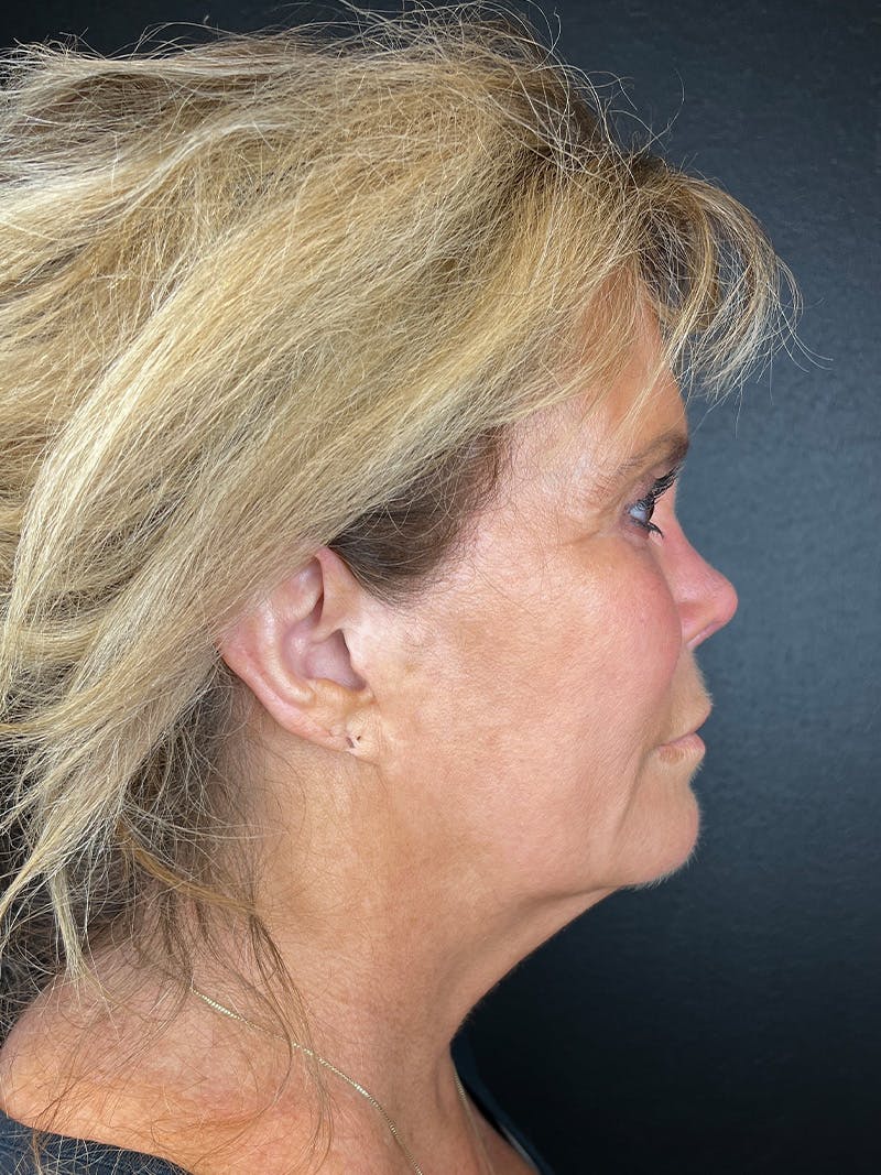 Neck Lift Before & After Gallery - Patient 383332 - Image 3