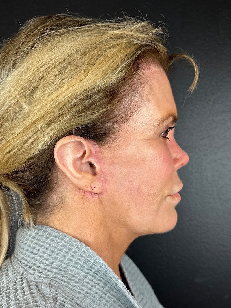 Neck Lift Before & After Gallery - Patient 383332 - Image 4