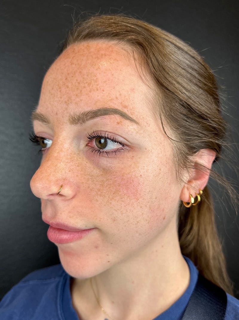 Hairline Advancement Before & After Gallery - Patient 254957 - Image 1