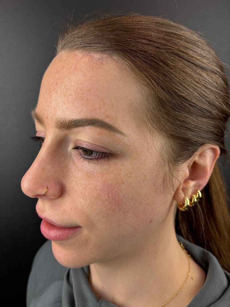 Hairline Advancement Before & After Gallery - Patient 254957 - Image 2