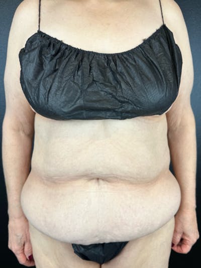 Tummy Tuck Before & After Gallery - Patient 629078 - Image 1
